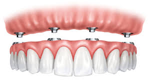 ALL ON 4 DENTAL IMPLANTS